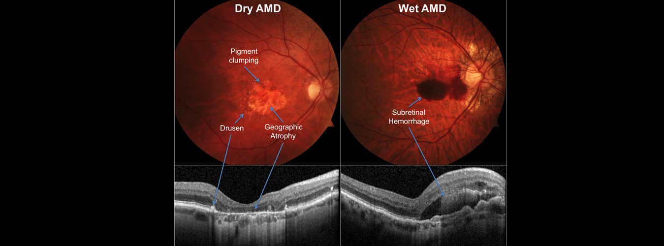 Optic Nerve Atrophy Treatment in India