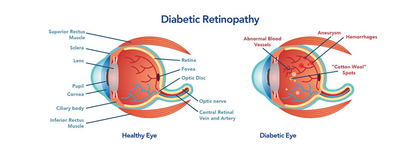 Eye stem cell treatment in India