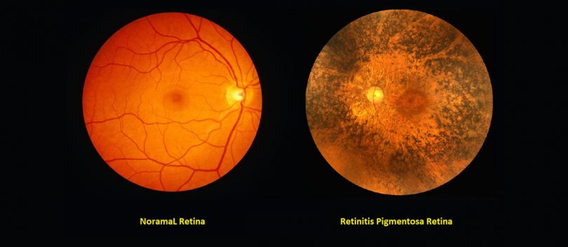 Retinitis Pigmentosa Treatment