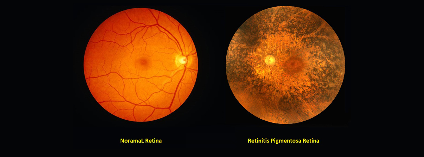 Retinitis Pigmentosa Treatment