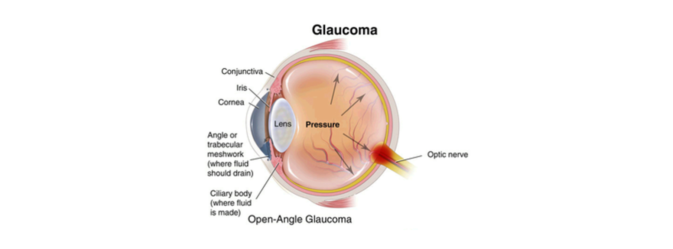 stem cell therapy for Glaucoma