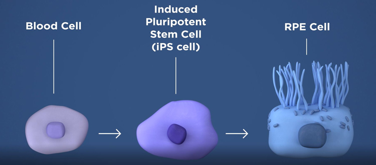 What-is-Stem-Cell-Treatment-for-Macular-Degeneration