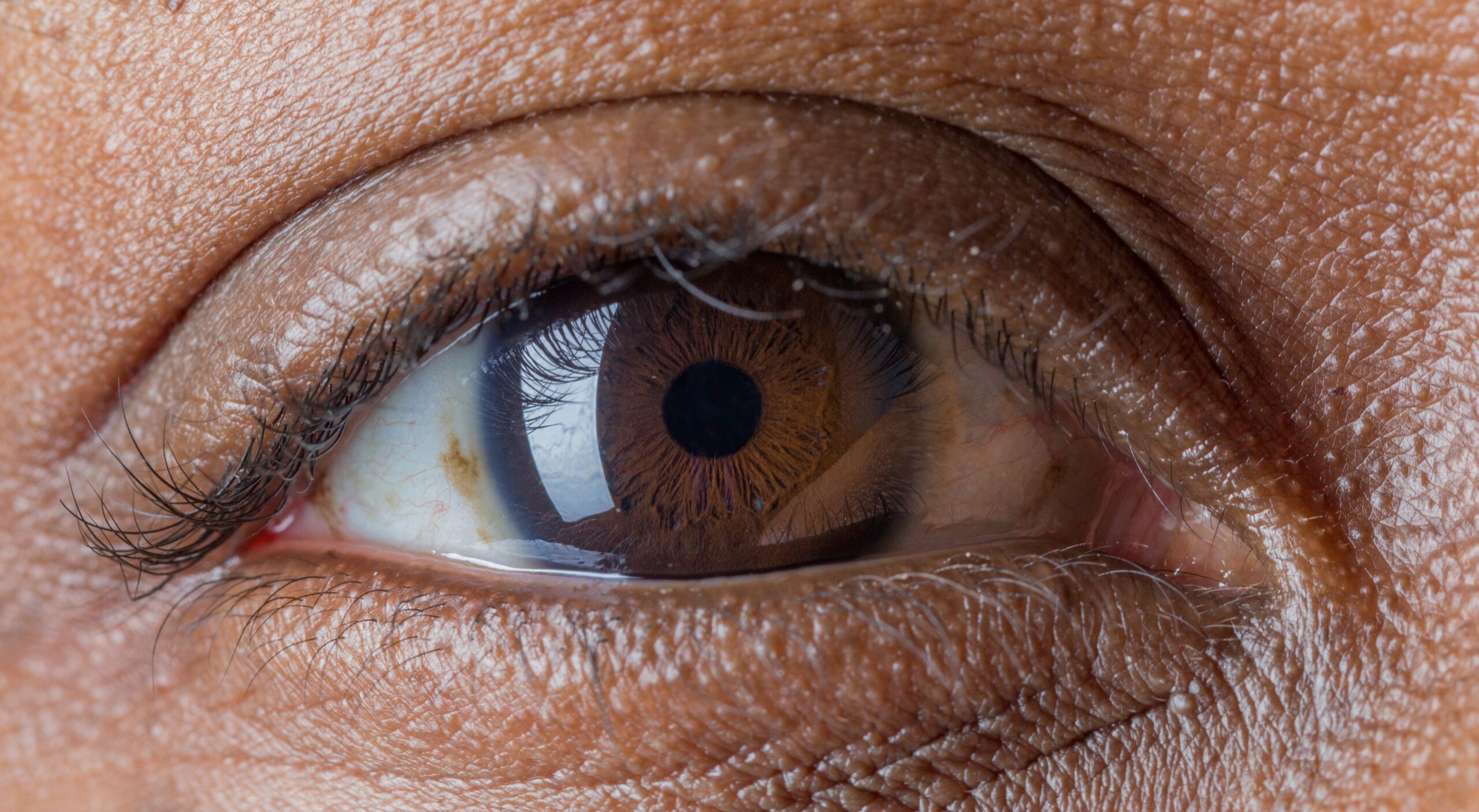 Stem cell therapy for retinitis pigmentosa in India
