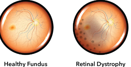 Stem cell treatment for retinal dystrophy in India