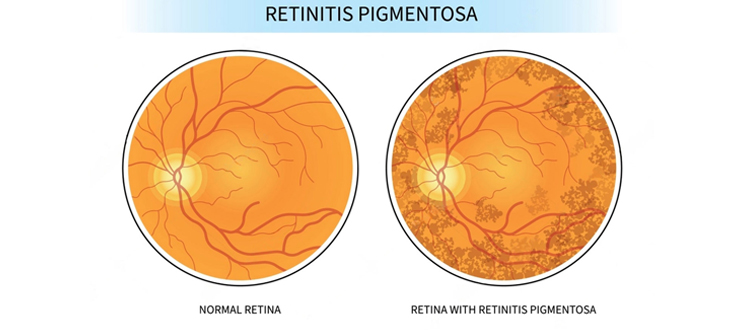 Cure-for-Blindness-Stem-Cell-Treatment-Retinitis-Pigmentosa