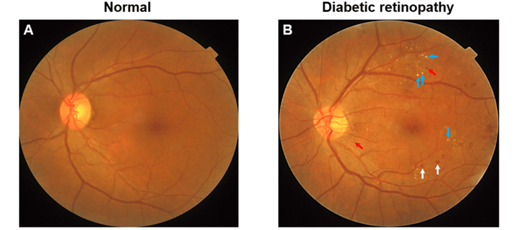 Diabetic Retinopathy