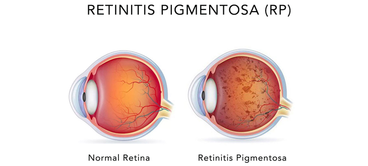 retinitis pigmentosa