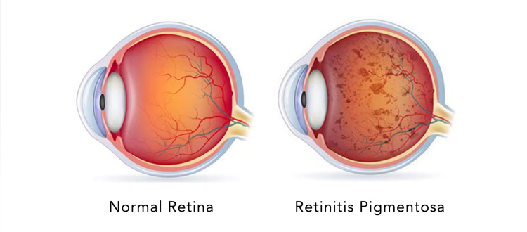 retinitis pigmentosa disease