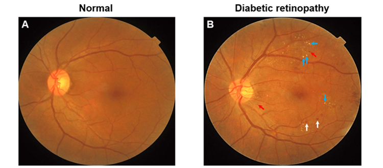 Diabetic-Retinopathy