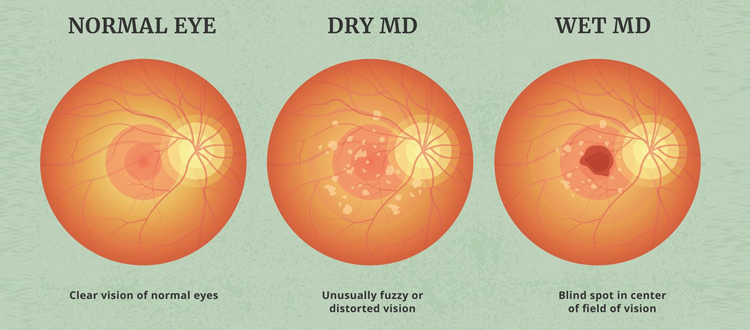 Macular-Degeneration