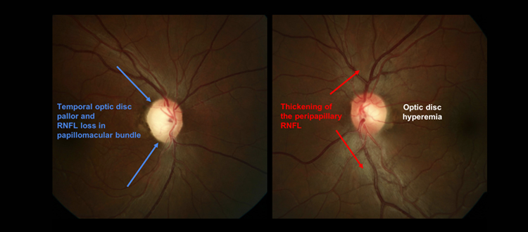 lhon treatment