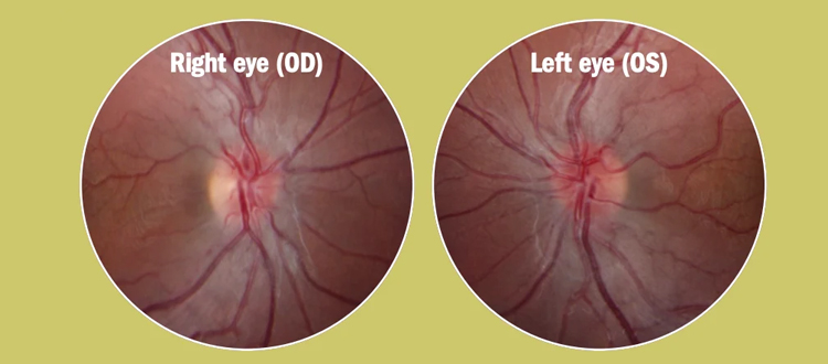 lhon treatment