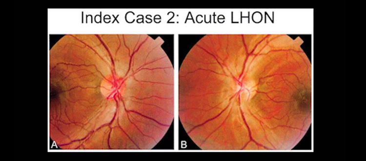 lhon treatment