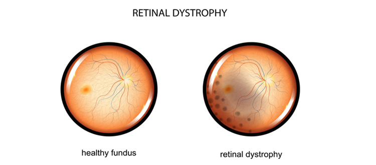 retinal dystrophy