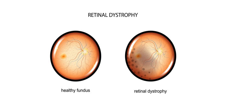 Retinal-destrophy