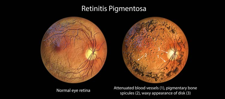 retinitis-pigmentosa