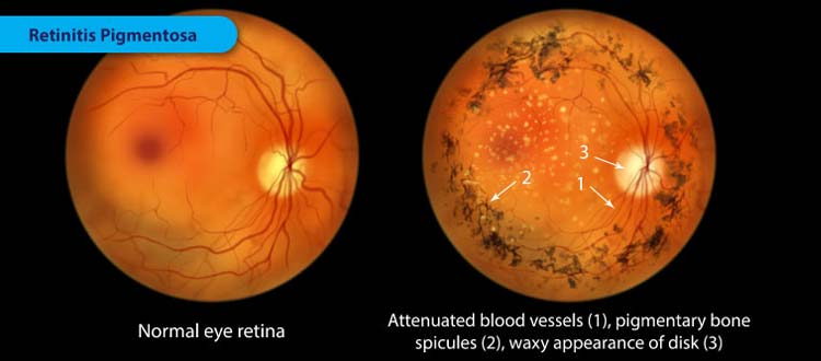retinitis-pigmentosa