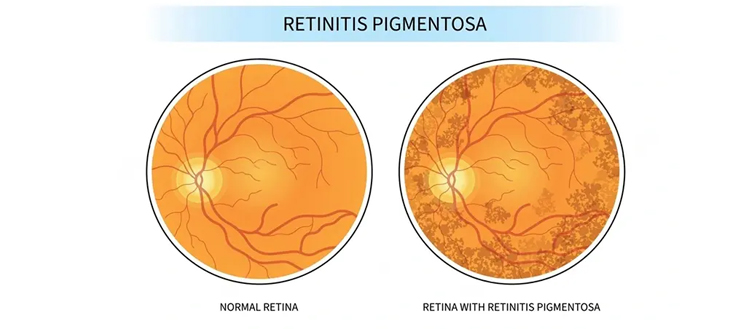 Retinitis_Pigmentosa