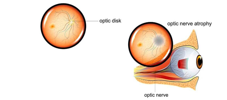 optic-atrophy