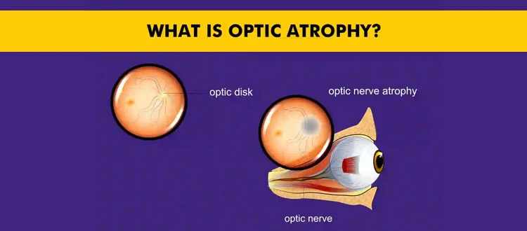 optic-atropy