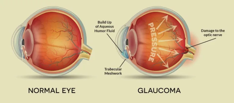 stem cell for optic-atropy