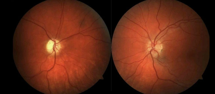 stem cell optic nerve