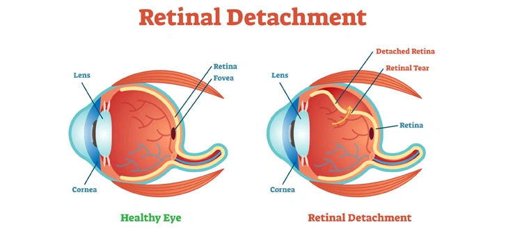 retinal-detachment