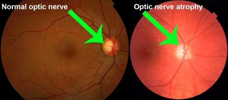 optic nerved