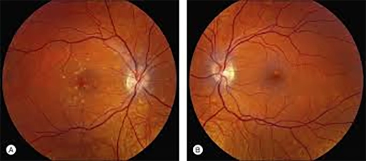 macular dystrophy