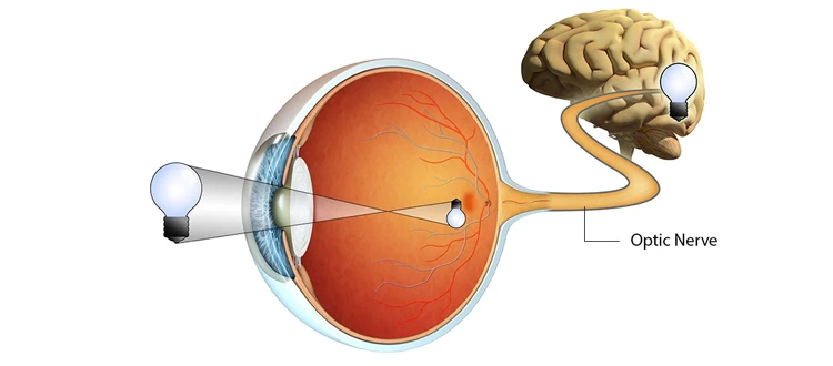 Optic Nerve Atrophy