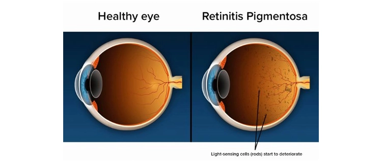 retinitis pigmentosa