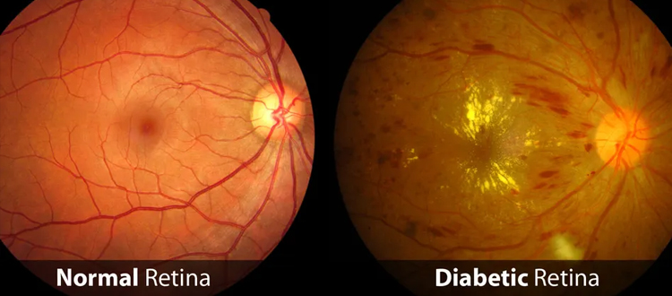 diabetic retinopathy
