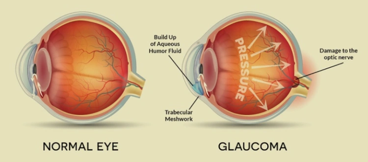 optic atrophy