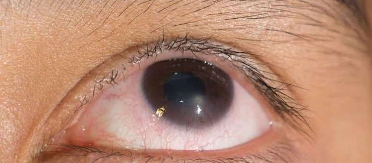 eye
