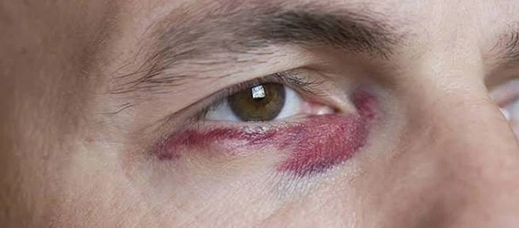 eye injury treatment