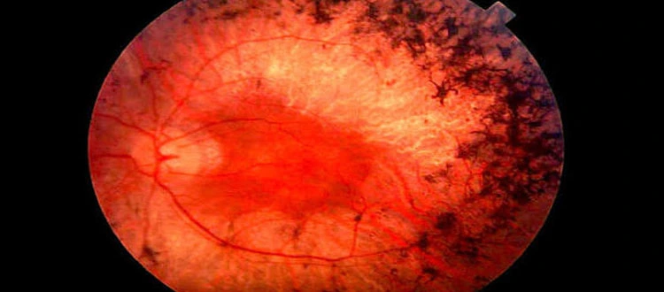 ushar syndrome