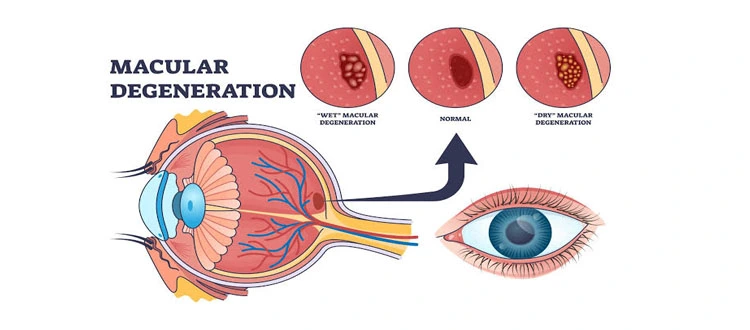 macular degeneration