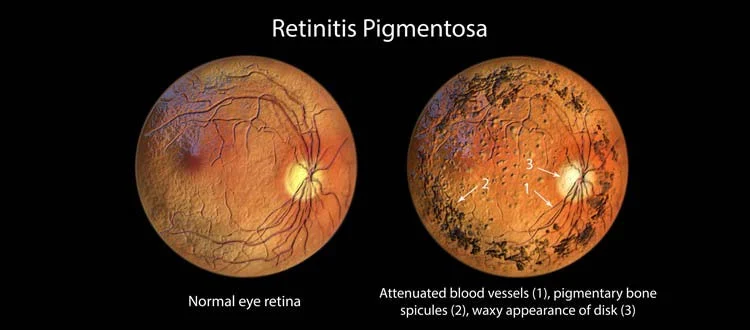 rp treatment in india